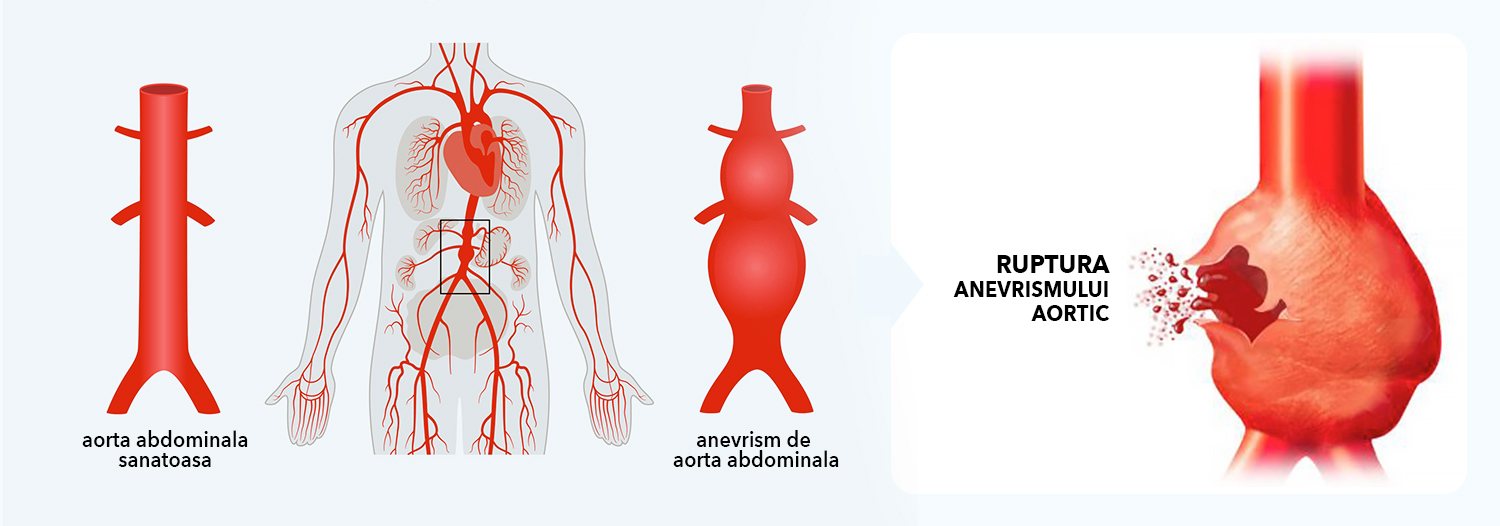 ruptura anevrismului aortic AAA